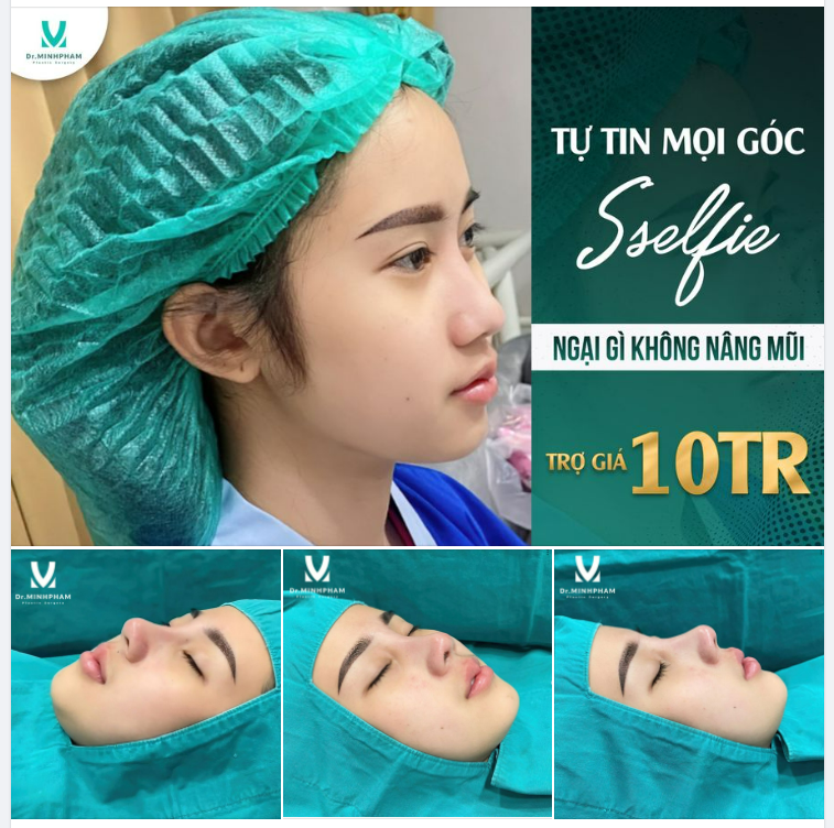 Khoe tác phẩm mũi đẹp thuận tự nhiên nhà Dr. Minh Phạm đẹp ngay sau làm!