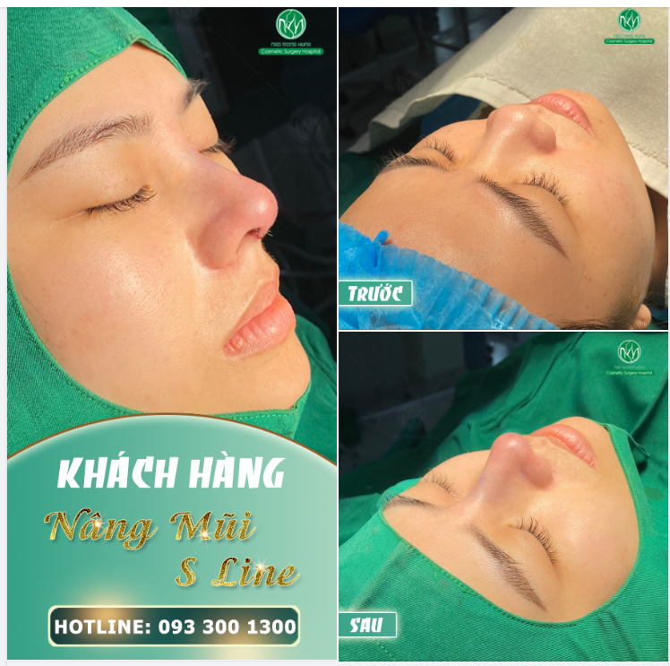 KHỞI ĐẦU NGÀY MỚI VỚI MỘT KẾT QUẢ NÂNG MŨI S LINE