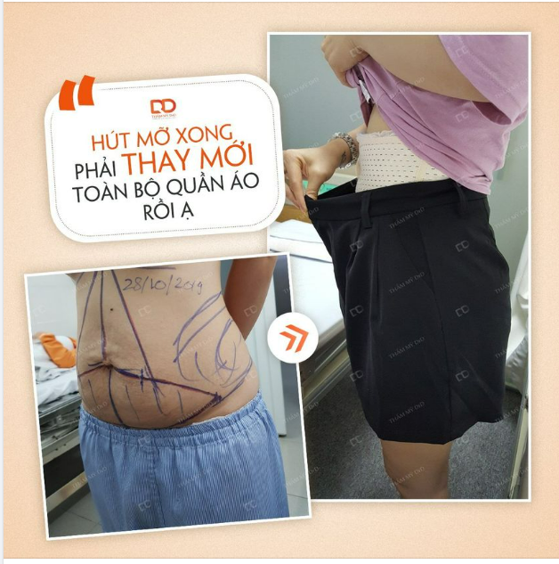 KHÔNG CÒN MẶC VỪA CÁI QUẦN NÀO VÌ BỤNG GIẢM HẲN 1 SIZE.