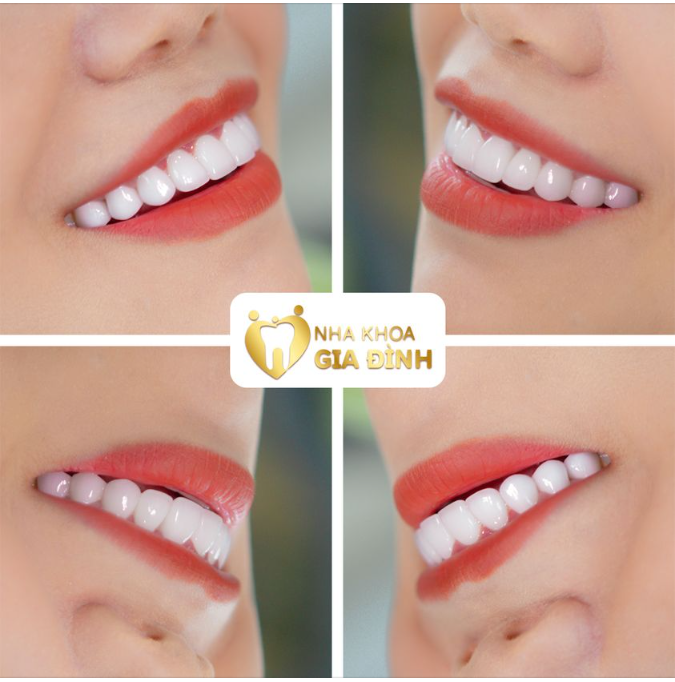 KHÔNG LÀM ĐẸP RĂNG PHÍ NỬA CUỘC ĐỜI