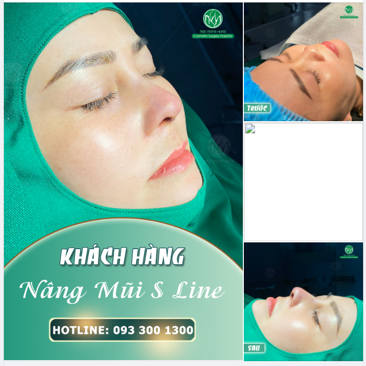 KHUÔN MẶT THANH TÚ HƠN NHỜ NÂNG MŨI