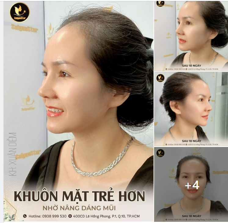 KHUÔN MẶT TRẺ HƠN NHỜ NÂNG MŨI