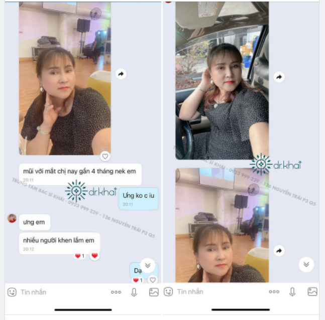 Khuôn mặt tươi trẻ với DÁNG MŨI CẤU TRÚC + cắt mí sau 4 tháng