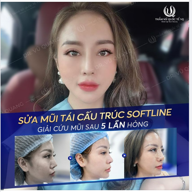 Kiên trì tìm kiếm cơ hội sau 5 lần nâng và sửa mũi bị hỏng....