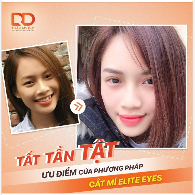 KỸ THUẬT CẮT MÍ ELITE EYES CÓ NHỮNG ƯU ĐIỂM GÌ