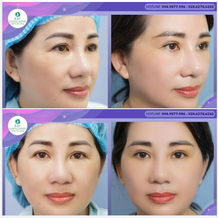  Kỹ thuật treo cung mày hay còn có tên gọi khác là treo cung mày trong thẩm mỹ là thủ thuật nhằm để loại bỏ phần da thừa ở phía trên hoặc phía dưới chân mày giúp làm kéo căng vùng da mắt, trả lại sự tươi trẻ cho gương mặt.