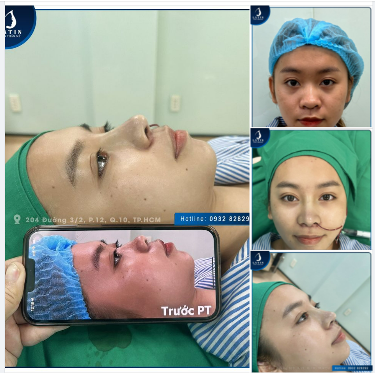 Lần đầu tiên nâng mũi sẽ như thế nào