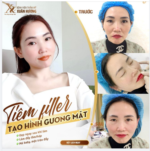 Tiêm filler môi có ảnh hưởng gì không Có hiệu quả bao lâu  Chi tiết tin  tức  Cổng thông tin điện tử tỉnh Bắc Giang