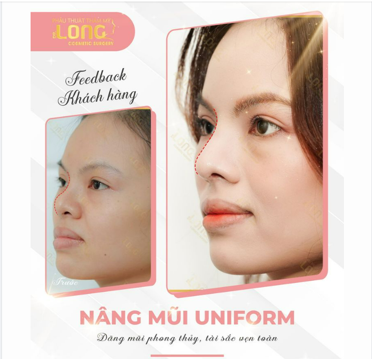 LẤY HẾT CAN ĐẢM ĐỂ NÂNG MŨI VÀ NHẬN LẠI THÀNH QUẢ HƠN CẢ MONG ĐỢI