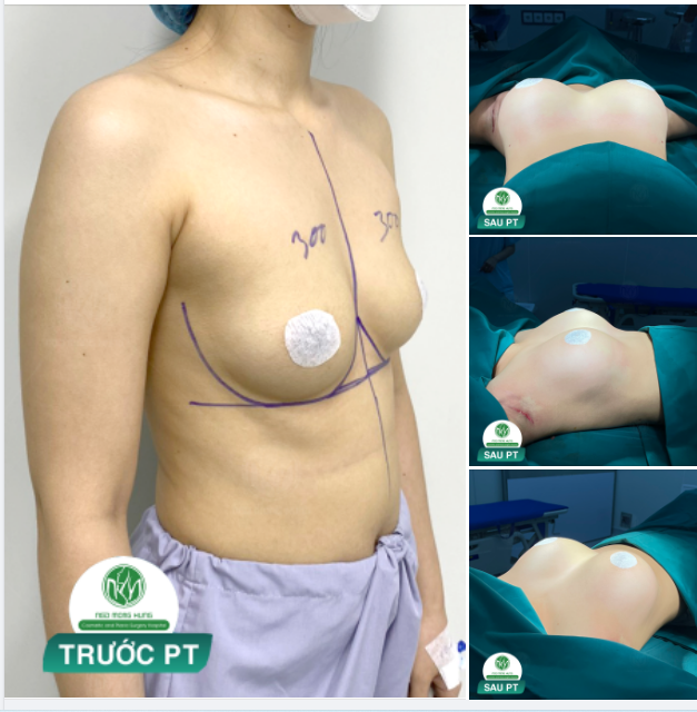 LẤY HẾT CAN ĐẢM ĐỂ THỰC HIỆN ƯỚC MƠ CÓ VÒNG 1 LÝ TƯỞNG