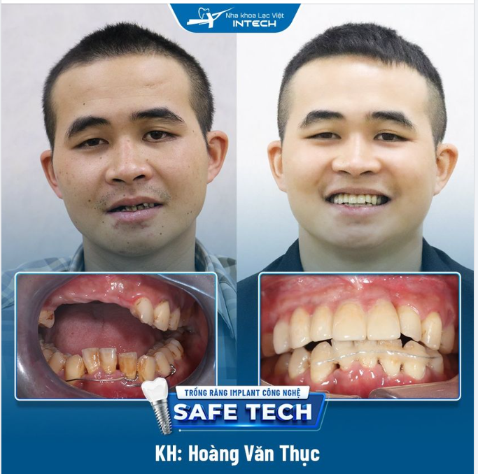 LẤY LẠI NỤ CƯỜI TƯ TIN VỚI TRỒNG RĂNG IMPLANT CÔNG NGHỆ SAFE-TECH