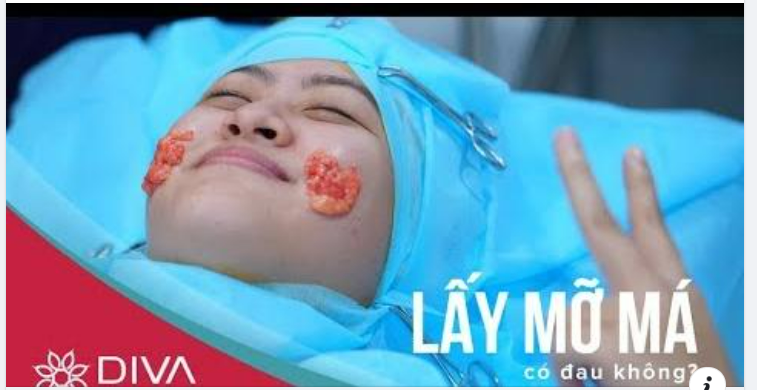 LẤY TÚI MỠ MÁ TRONG - CỨU CÁNH CHO MẶT TRÒN PHÍNH MỠ