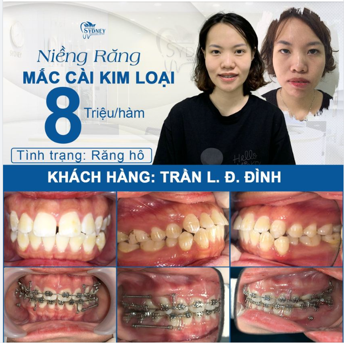 LỆCH MẶT CẢI THIỆN THẾ NÀO