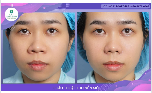 Lỗ mũi to, cánh mũi rộng và bẹt khiến gương mặt bạn thiếu sự hẹ nhàng và thanh thoát