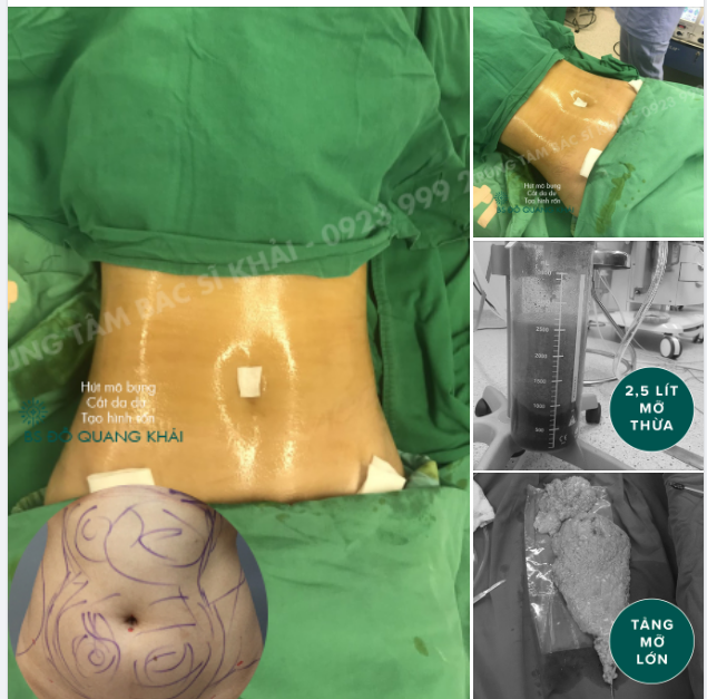 LOẠI BỎ HƠN 5KG MỠ THỪA RA KHỎI CƠ THỂ KHÁCH HÀNG PP HÚT MỠ BỤNG ULTRA Z XỊN NHẤT NĂM 2022.