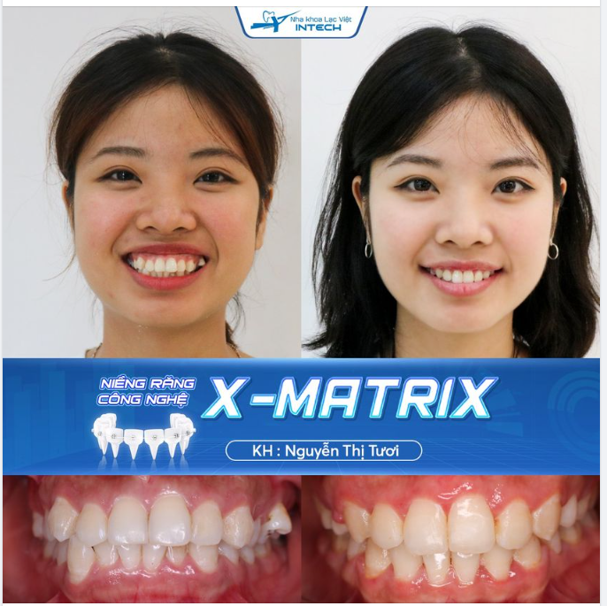 LOẠI BỎ RĂNG HÔ NHỜ NIỀNG RĂNG CÔNG NGHỆ X- MATRIX
