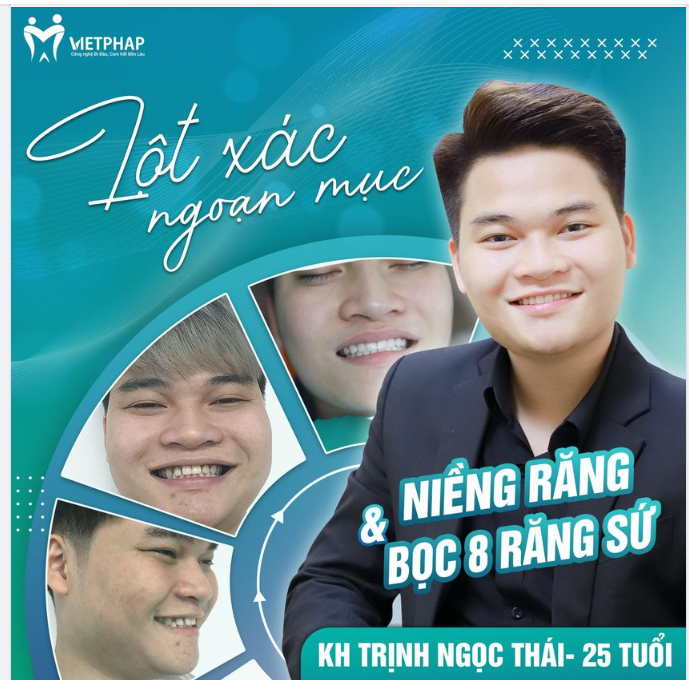 LỘT XÁC NỤ CƯỜI: NIỀNG RĂNG  -  BỌC RĂNG SỨ