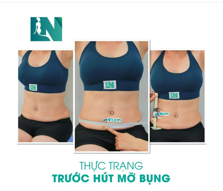 LỰA CHỌN GIẢM MỠ - TRỞ LẠI DÁNG VÓC THANH XUÂN VỚI HÚT MỠ TẠO DÁNG CHO CHỊ KH VIỆT KIỂU SN 1968 TRỰC TIẾP VÀO 15H00-16H00 HÔM NAY