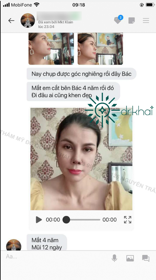 MẮT EM CẮT BÊN BÁC 4 NĂM RỒI ĐÓ ĐI ĐÂU AI CŨNG KHEN ĐẸP
