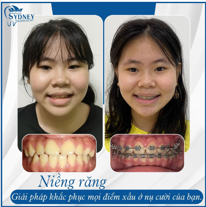 MẶT LỆCH CÓ NIỀNG RĂNG ĐƯỢC KHÔNG 