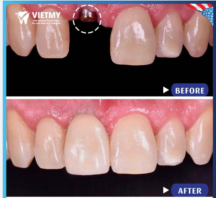 MẤT RĂNG CỬA- TRỒNG RĂNG IMPLANT NGAY