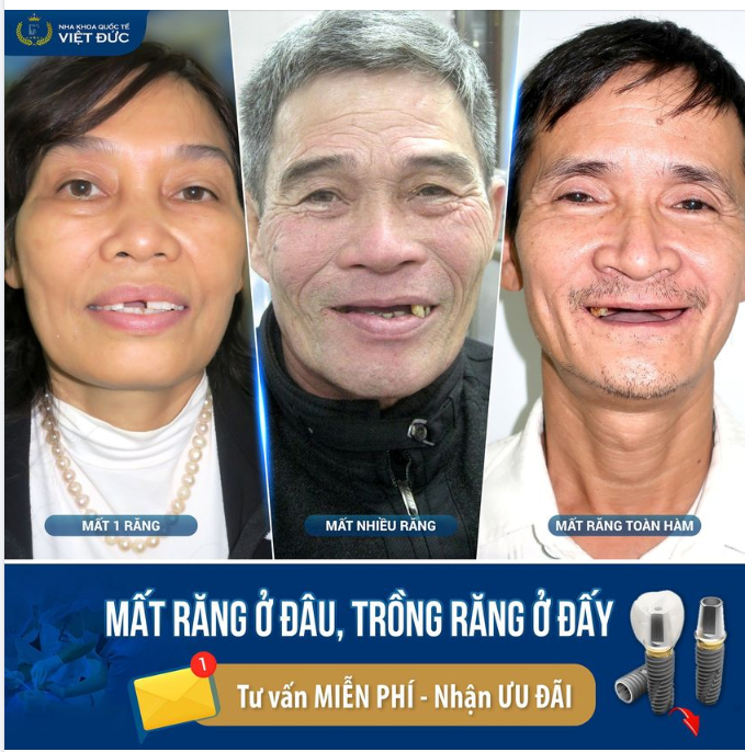 MẤT RĂNG Ở ĐÂU, TRỒNG RĂNG Ở ĐẤY