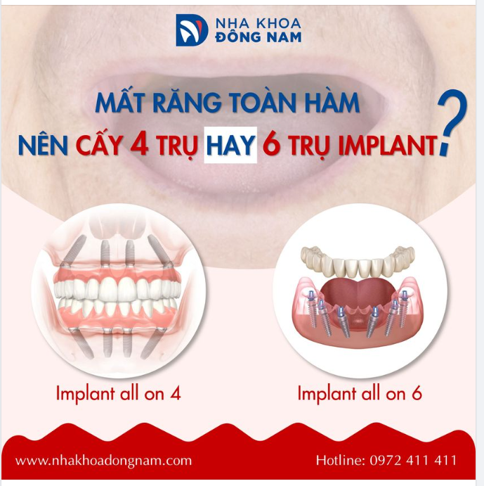 MẤT RĂNG TOÀN HÀM NÊN CẤY 4 TRỤ HAY 6 TRỤ IMPLANT 