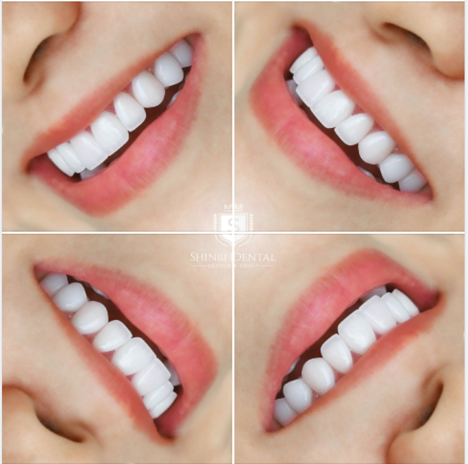 MẸO GIÚP NỤ CƯỜI CỦA BẠN LUÔN THU HÚT