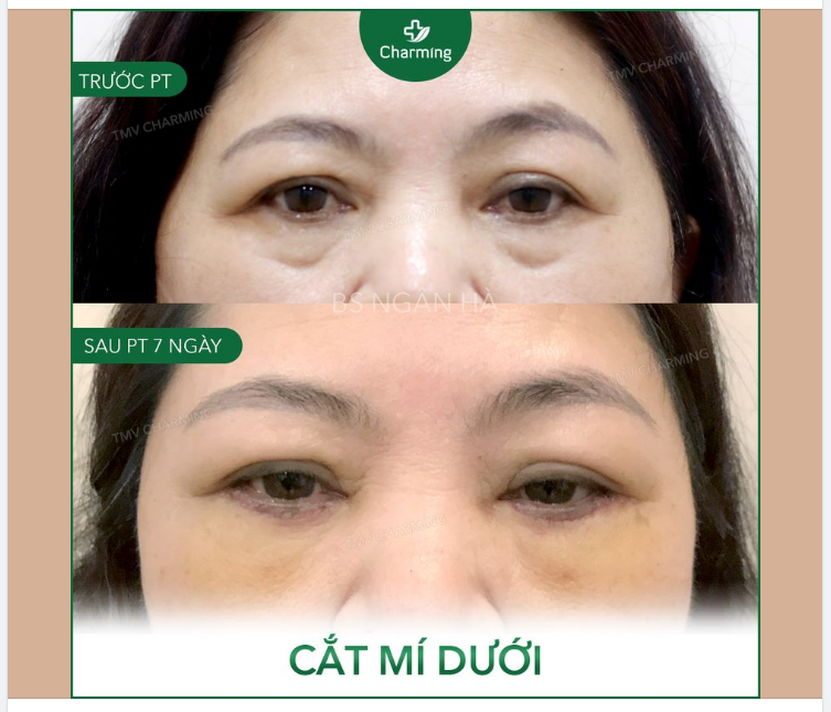Mí dưới phồng to ra thì cũng là chuyện bình thường, nhưng bọng mí hơi phồng lên một tí mà đã tạo 2 đường lõm ở mí dưới thì…cũng bình thường luôn ​​​​​​​ Chỉ là hơi kém duyên một tí thôi