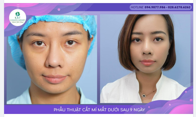 “Mọi ưu sầu mệt mỏi tan theo phẫu thuật cắt mí dưới”