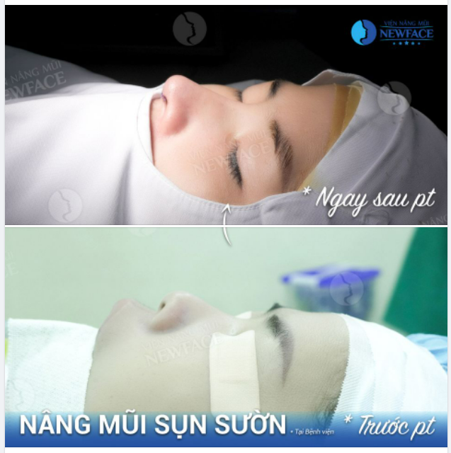 MỘT CA SỤN SƯỜN SỚM VỪA HOÀN THÀNH