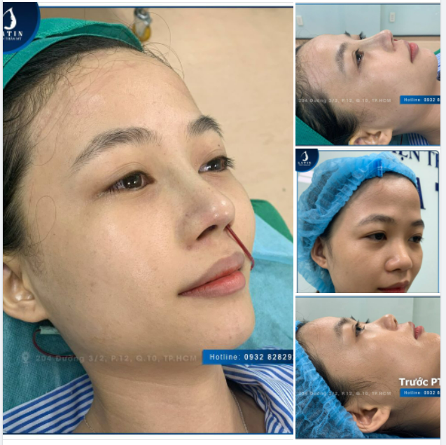 Một chiếc mũi xinh đến từ nhà Latin