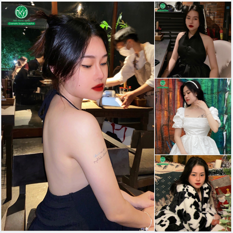 MỘT PHIÊN BẢN XINH ĐẸP HƠN CỦA KH SAU NÂNG MŨI TẠI BỆNH VIỆN