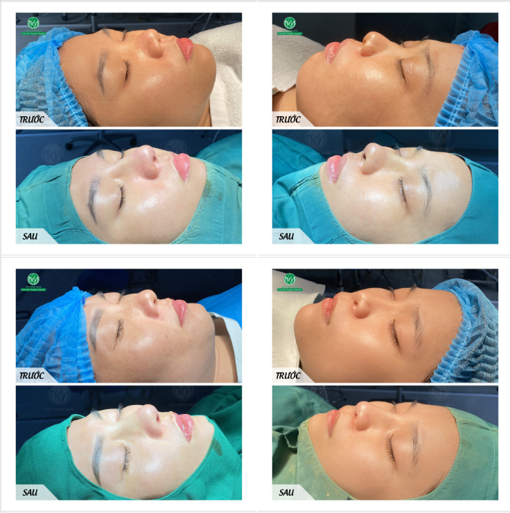 MỘT VÀI KẾT QUẢ ĐẸP SAU NÂNG MŨI