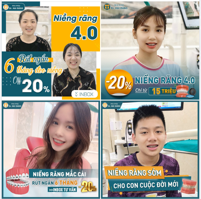 Mùa hè - Thời điểm lý tưởng để các bạn trẻ thực hiện niềng răng