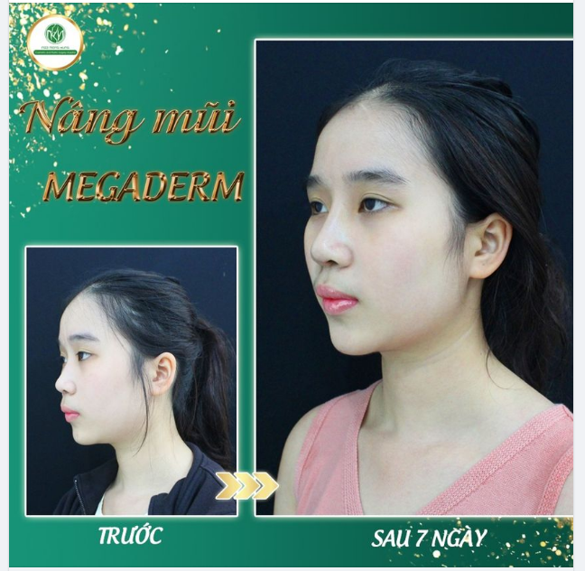 MŨI 7 NGÀY TUỔI - FORM ĐẸP TỰ NHIÊN
