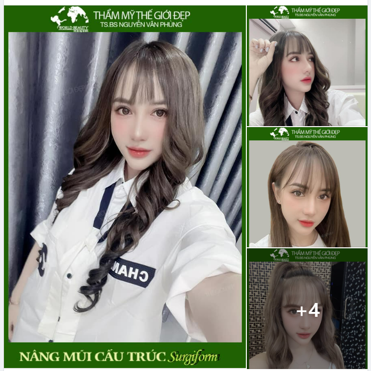 Mũi bẩm sinh nhiều khuyết điểm, quý Cô tìm đến giải pháp N.âng mũi cấu trúc Surgiform sụn tự thân tại Thế Giới Đẹp và cái kết mỹ mãn