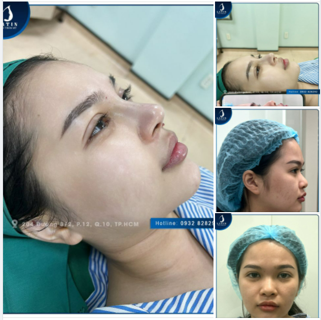 Mũi bán cấu trúc chỉnh hình và lót Megaderm vừa xong xuất sắc, đúng theo yêu cầu tự nhiên cho bạn gái.