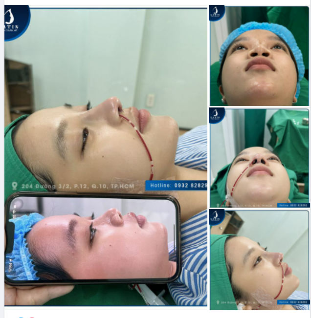 Mũi bán cấu trúc cho bạn khách trẻ