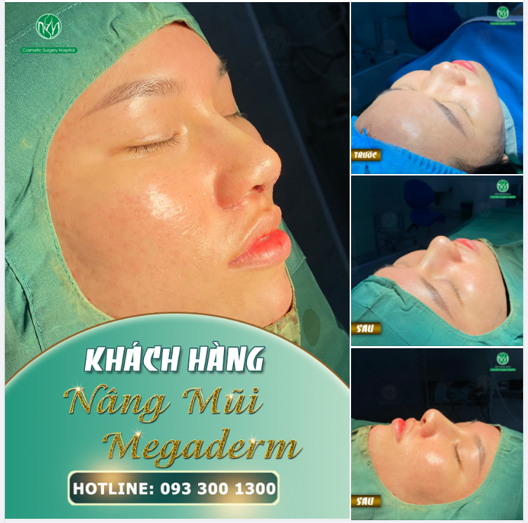 MŨI CHUẨN ĐIỂM 10 TẠI BỆNH VIỆN