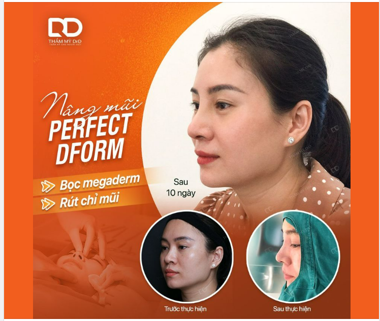 MŨI ĐÃ CẤY CHỈ RỒI CÓ NÂNG MŨI LẠI ĐƯỢC KHÔNG