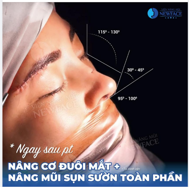 MŨI ĐẠT CHUẨN TỶ LỆ VÀNG LIỆU CÓ CẦN THIẾT