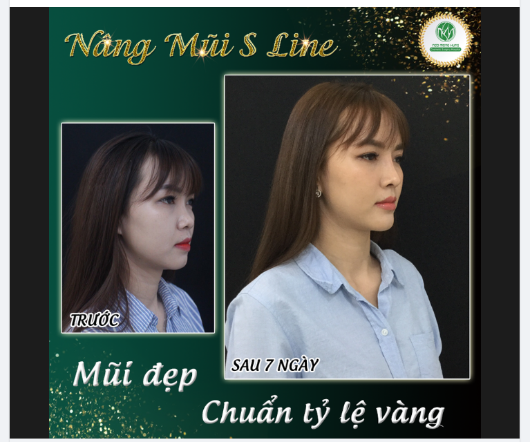 MŨI ĐẸP CHUẨN TỶ LỆ VÀNG