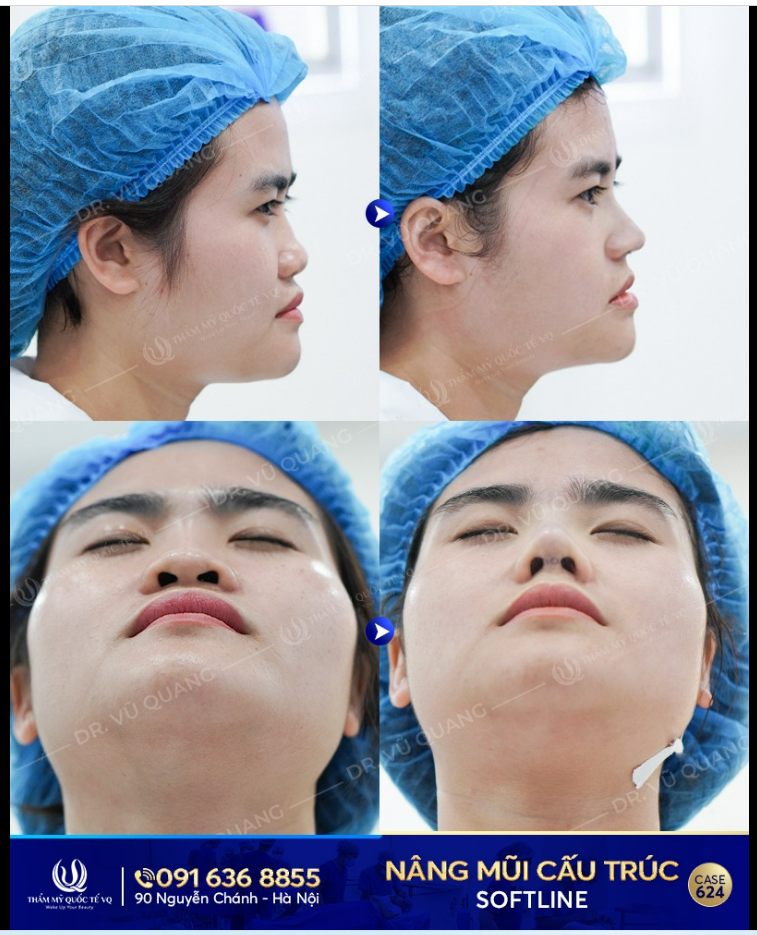 Mũi đẹp tự nhiên nhưng không tự nhiên mà đẹp