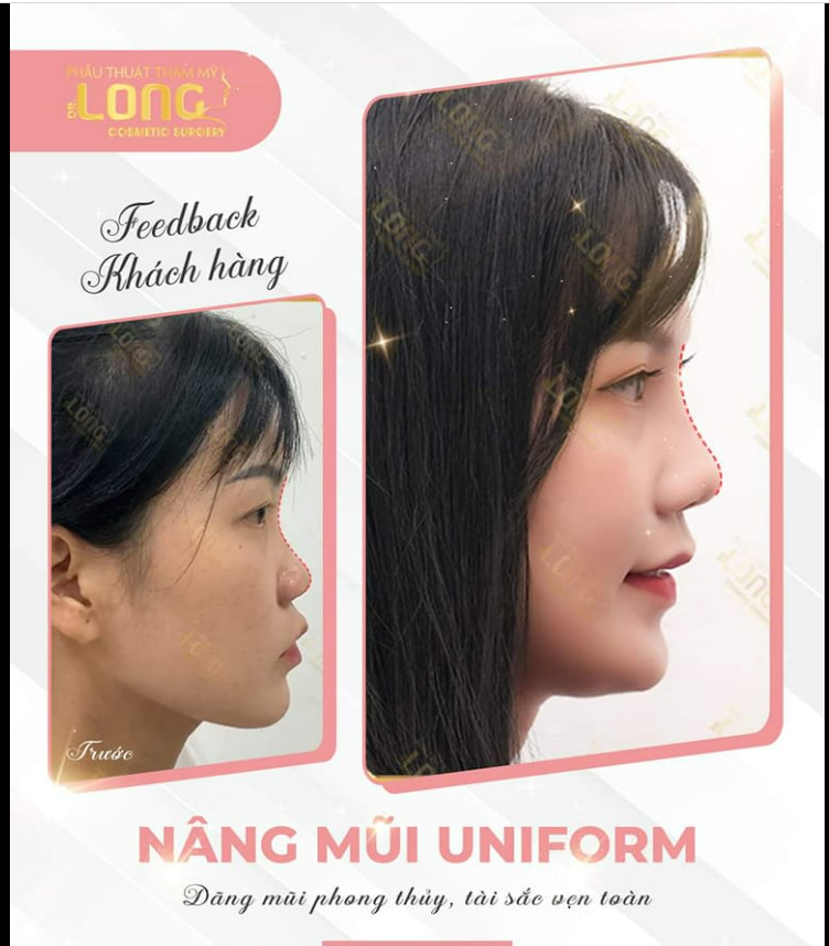 MŨI ĐẸP XINH - RINH ƯU ĐÃI