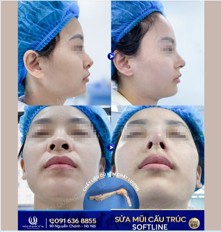 MŨI HỎNG khiến bạn lao đao. MŨI LỆCH khiến bạn xấu hổ. MŨI GỒ làm bạn kém may mắn. MŨI HẾCH làm bạn rơi hết tiền...