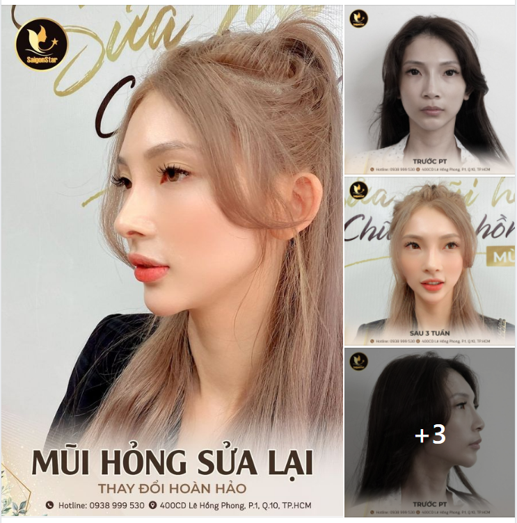 MŨI HỎNG SỬA LẠI - THAY ĐỔI HOÀN HẢO