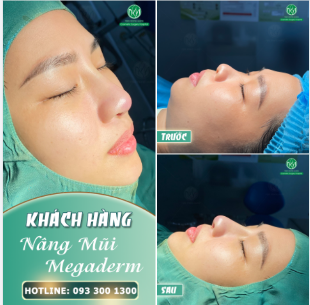 MŨI MEGADERM VỪA HOÀN THÀNH ĐÃ ĐẸP NHƯ NÀY RỒI ĐÂY!!