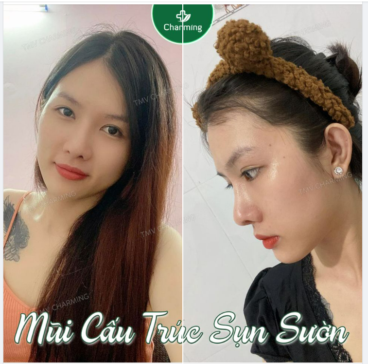Mũi nâng cấu trúc gọn gàng. Làm cho gương mặt của nàng xinh thêm