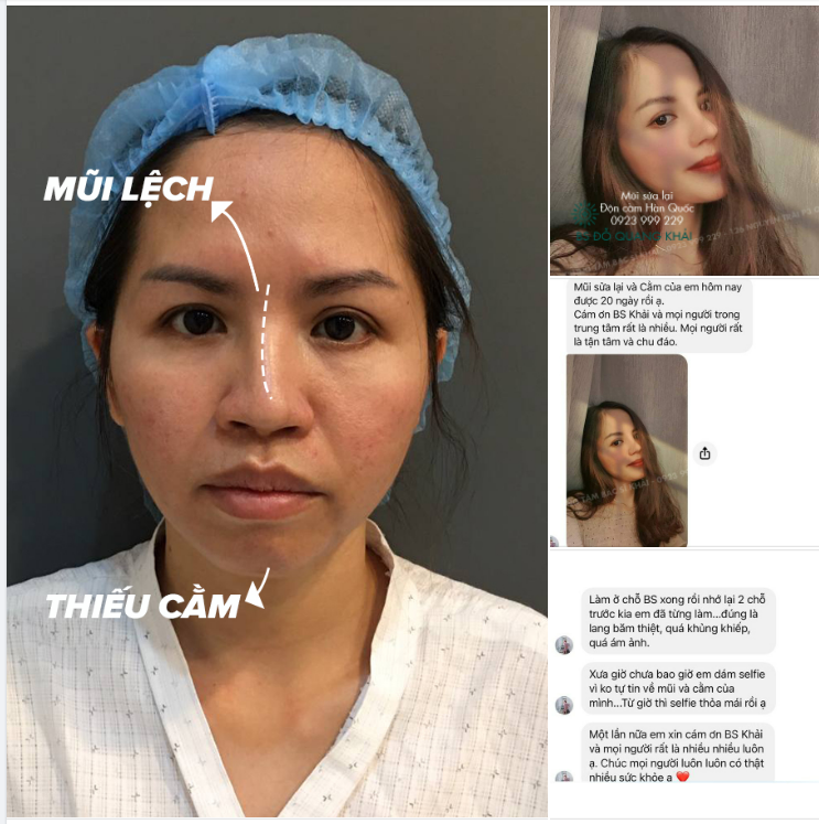 MŨI SỬA LẠI, ĐỘN CẰM HÀN QUỐC VỚI GIÁ VÔ CÙNG ƯU ĐÃI